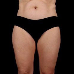 Liposuction Before & After Patient #1500