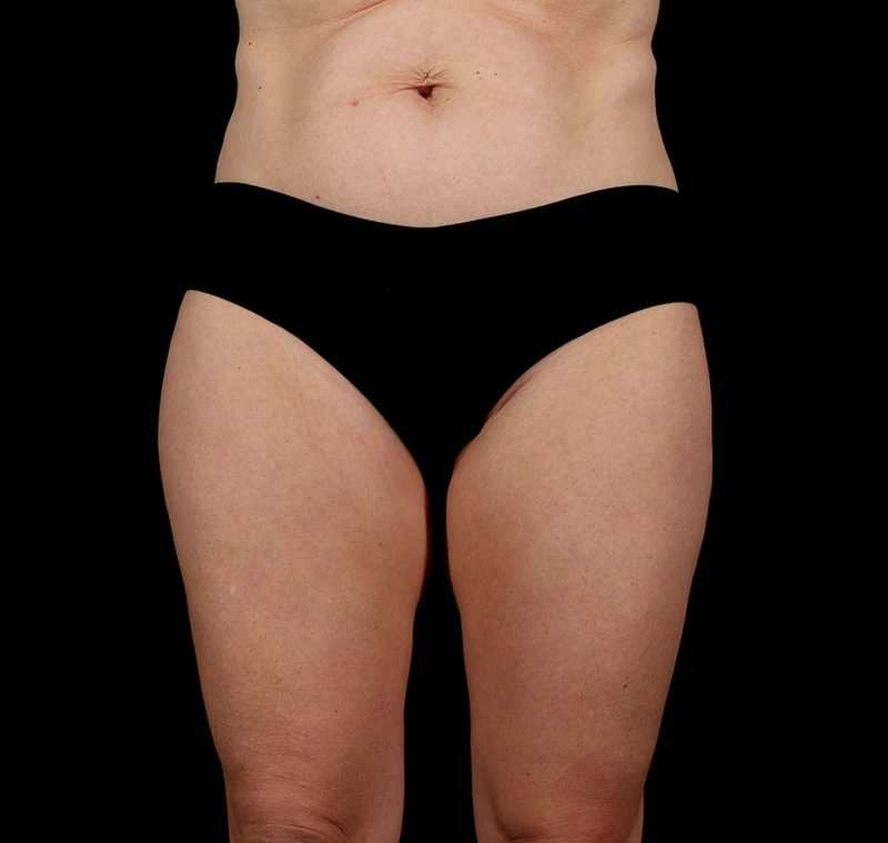 Liposuction Before & After Patient #1500