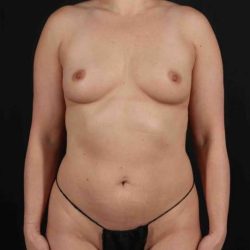 Liposuction Before & After Patient #1513