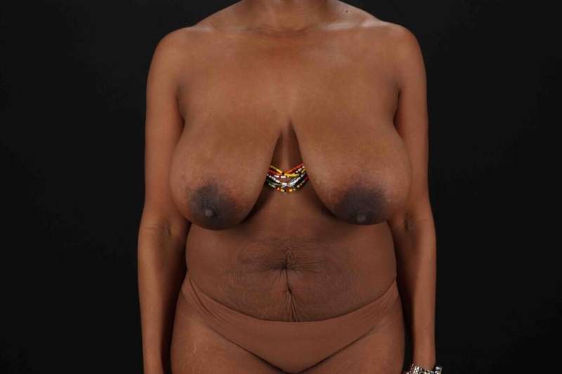 Liposuction Before & After Patient #1524