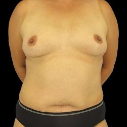 Mommy Makeover Before & After Patient #1547