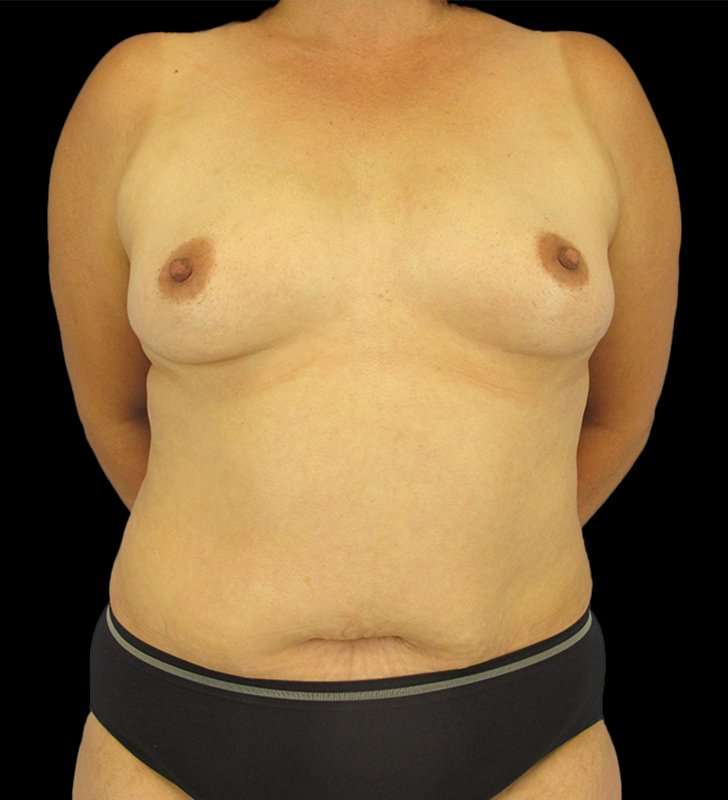 Mommy Makeover Before & After Patient #1547