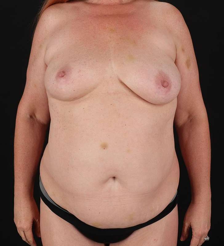 Mommy Makeover Before & After Patient #1671