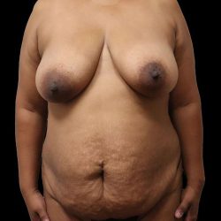Mommy Makeover Before & After Patient #1685
