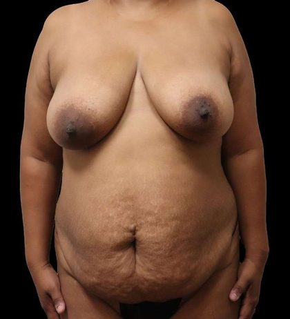Mommy Makeover Before & After Patient #1685