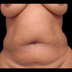 Abdominoplasty (Tummy Tuck) Before & After Patient #675