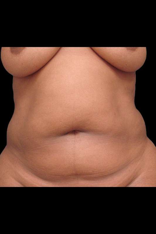 Abdominoplasty (Tummy Tuck) Before & After Patient #675