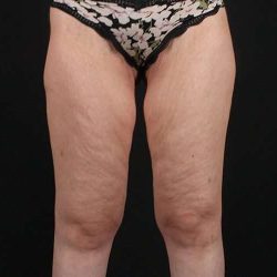 Thigh Lift Before & After Patient #1756
