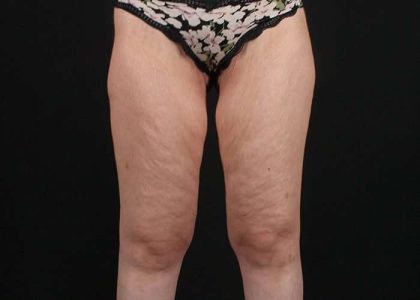 Thigh Lift Before & After Patient #1756