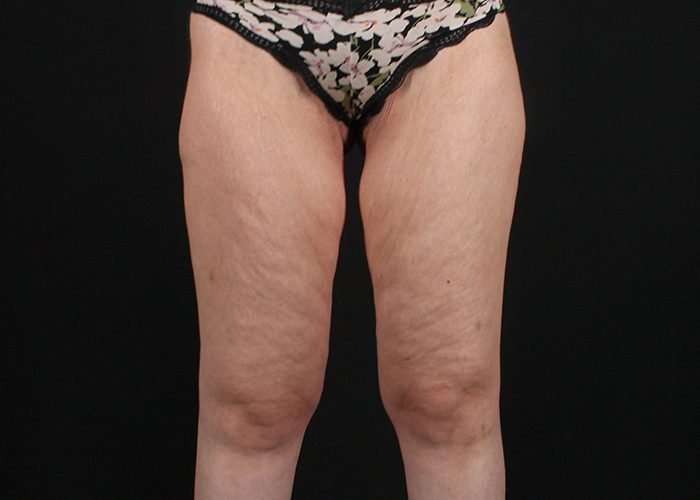 Thigh Lift Before & After Patient #1756