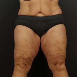 Thigh Lift Before & After Patient #1762