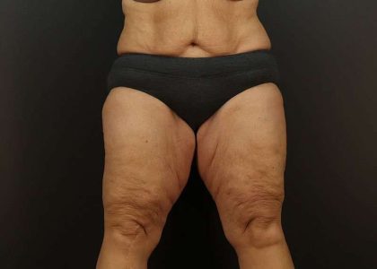 Thigh Lift Before & After Patient #1762