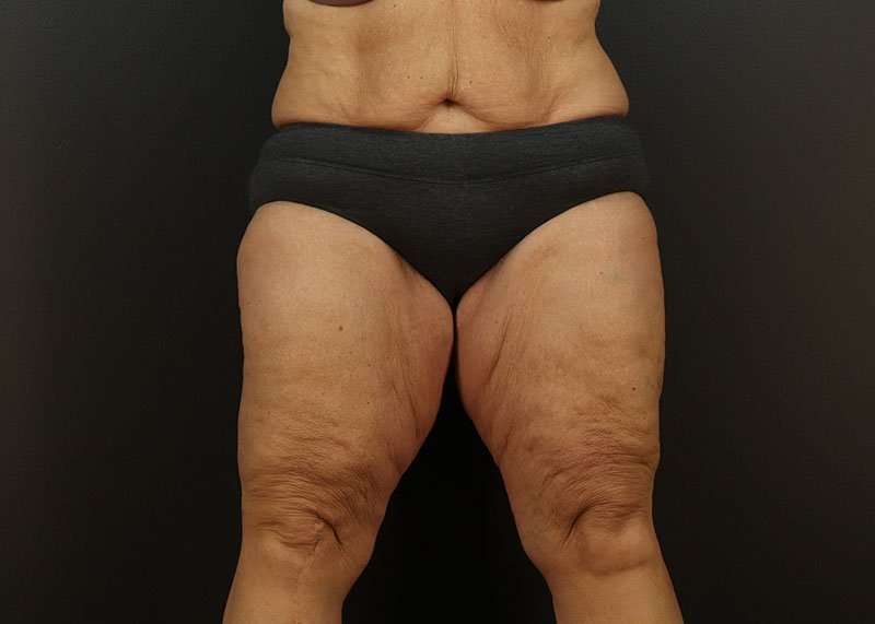 Thigh Lift Before & After Patient #1762