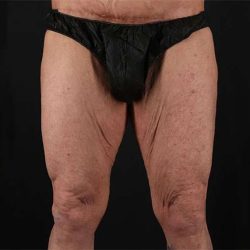 Thigh Lift Before & After Patient #1776