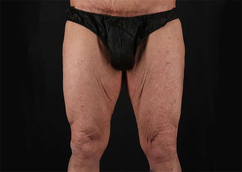 Thigh Lift Before & After Patient #1776