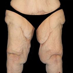 Thigh Lift Before & After Patient #1790