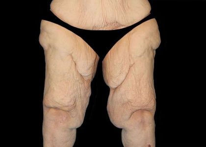 Thigh Lift Before & After Patient #1790