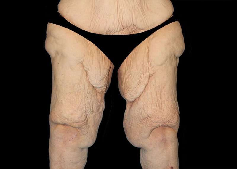 Thigh Lift Before & After Patient #1790