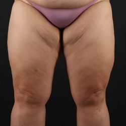 Thigh Lift Before & After Patient #1804