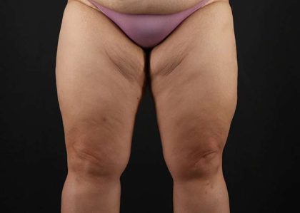 Thigh Lift Before & After Patient #1804