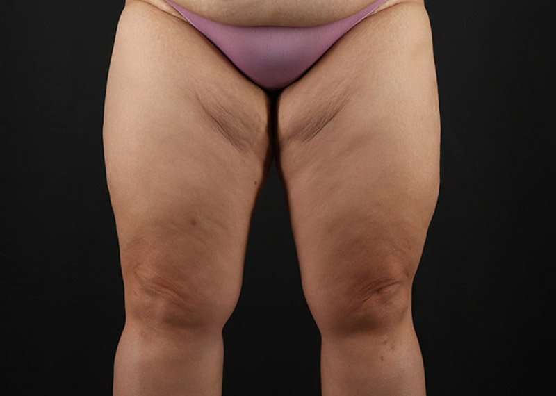 Thigh Lift Before & After Patient #1804