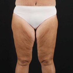 Thigh Lift Before & After Patient #1818