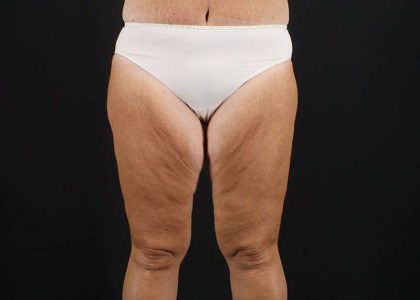 Thigh Lift Before & After Patient #1818