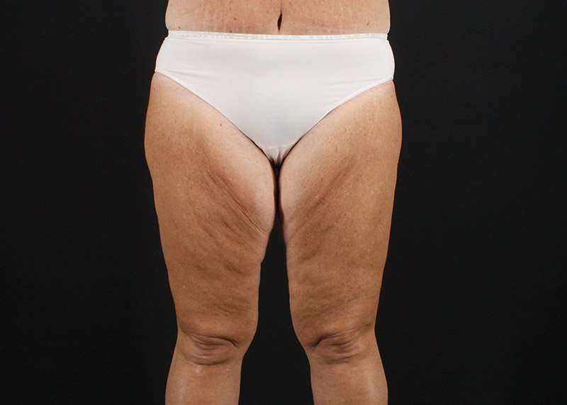 Thigh Lift Before & After Patient #1818