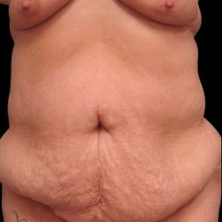 Abdominoplasty (Tummy Tuck) Before & After Patient #680