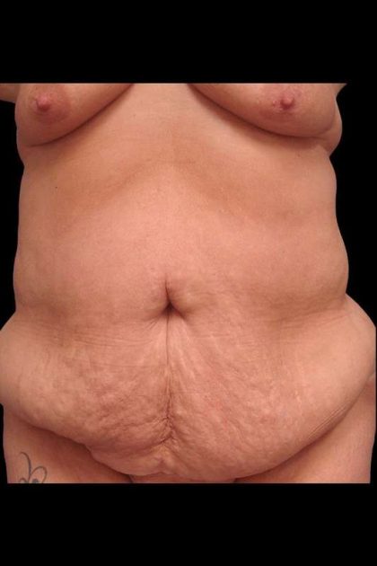 Abdominoplasty (Tummy Tuck) Before & After Patient #680