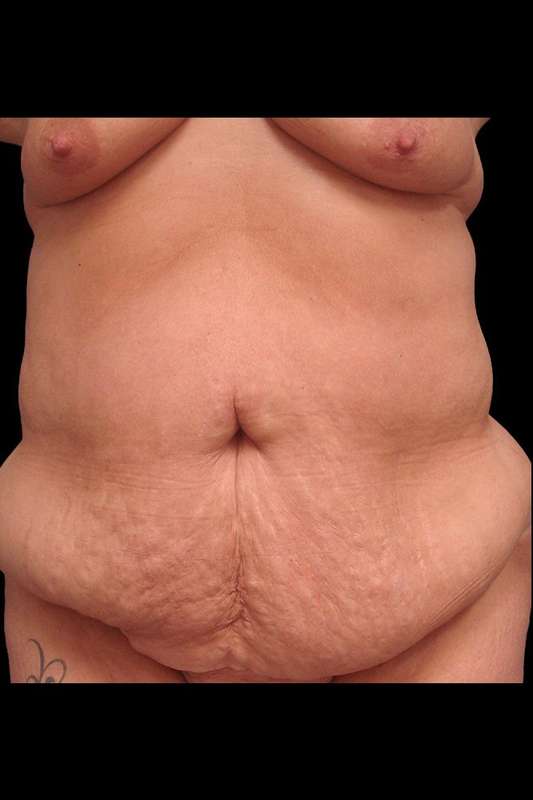 Abdominoplasty (Tummy Tuck) Before & After Patient #680