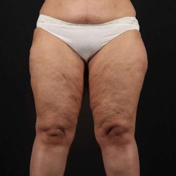 Thigh Lift Before & After Patient #1831