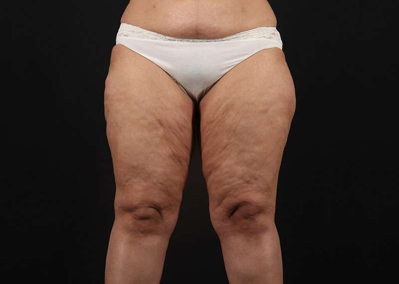 Thigh Lift Before & After Patient #1831