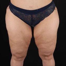 Thigh Lift Before & After Patient #1844