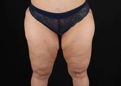Thigh Lift Before & After Patient #1844