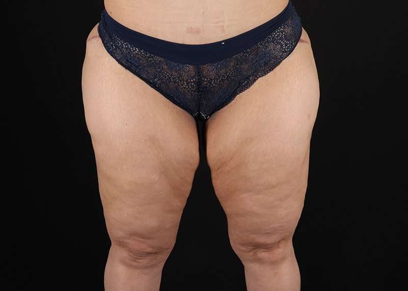 Thigh Lift Before & After Patient #1844