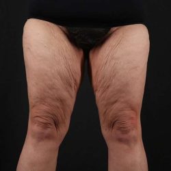 Thigh Lift Before & After Patient #1857
