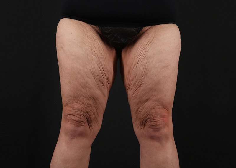 Thigh Lift Before & After Patient #1857