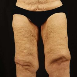 Thigh Lift Before & After Patient #1871