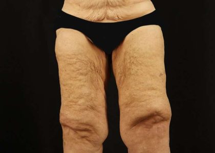 Thigh Lift Before & After Patient #1871