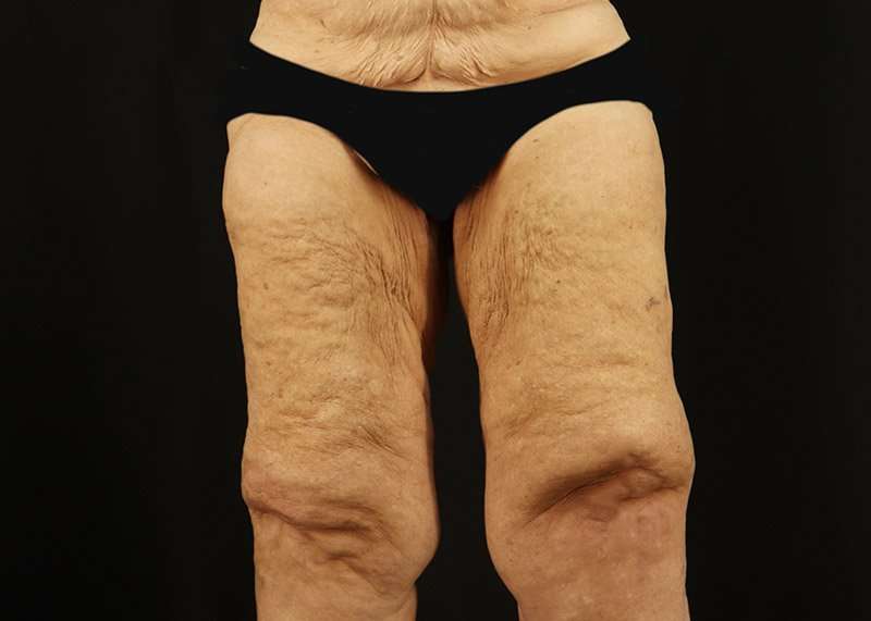 Thigh Lift Before & After Patient #1871