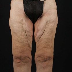 Thigh Lift Before & After Patient #1884