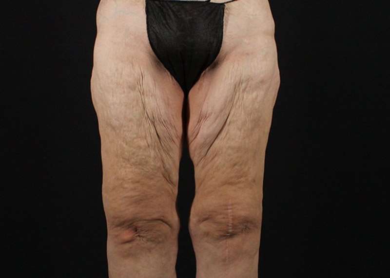 Thigh Lift Before & After Patient #1884