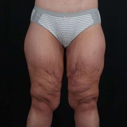 Thigh Lift Before & After Patient #1897