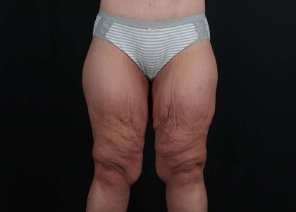 Thigh Lift Before & After Patient #1897