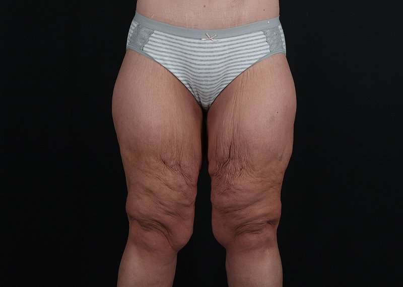 Thigh Lift Before & After Patient #1897