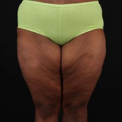 Thigh Lift Before & After Patient #1911