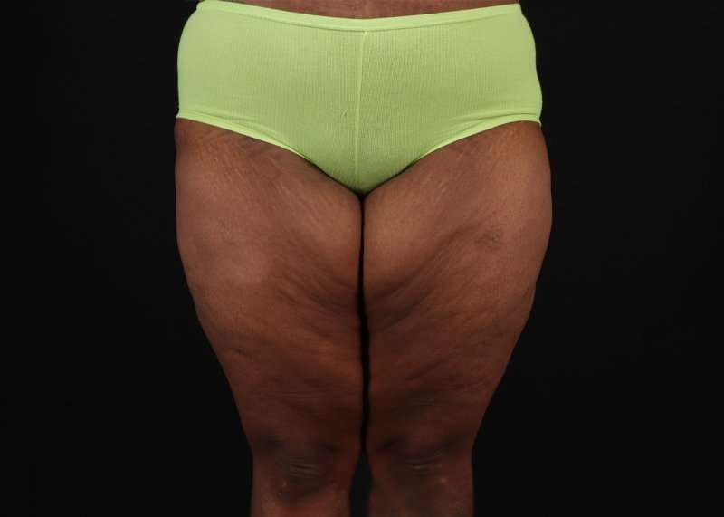 Thigh Lift Before & After Patient #1911
