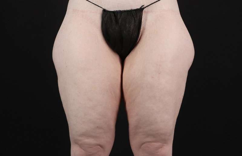 Thigh Lift Before & After Patient #1925