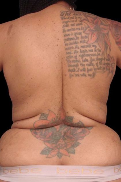 Back Lift/Tuck Before & After Patient #1928